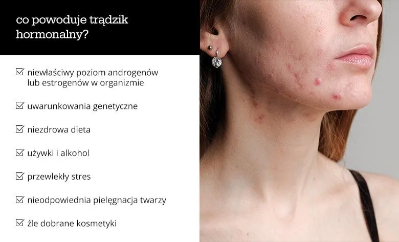 wpływ hormonów na skórę trądzikową