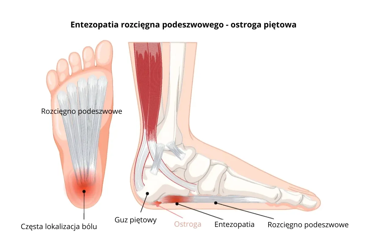 Ilustracja pokazuje zapalenie rozcięgna podeszwowego objawy: ból pięty, ostrogę i guzek.