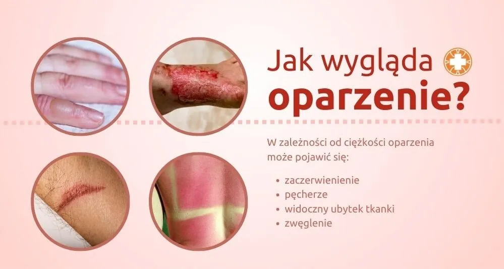 Zdjęcie Do jakiego lekarza z oparzeniem? Kluczowe informacje, które musisz znać