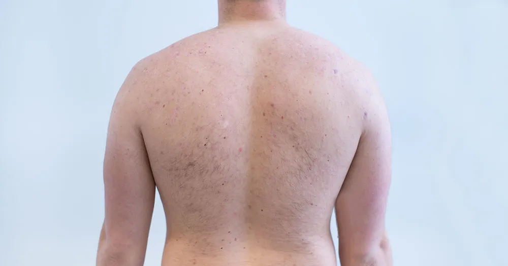 dermatolog konsultacja trądzik plecy