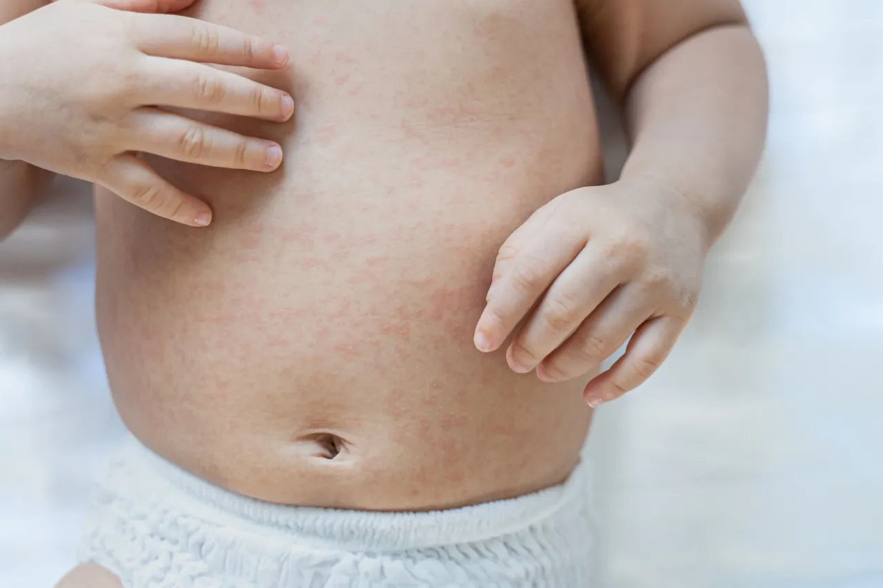 Dziecko ma atopowe zapalenie skóry na brzuchu, widoczne jako czerwone plamki. Rączki dziecka delikatnie dotykają podrażnionej skóry.