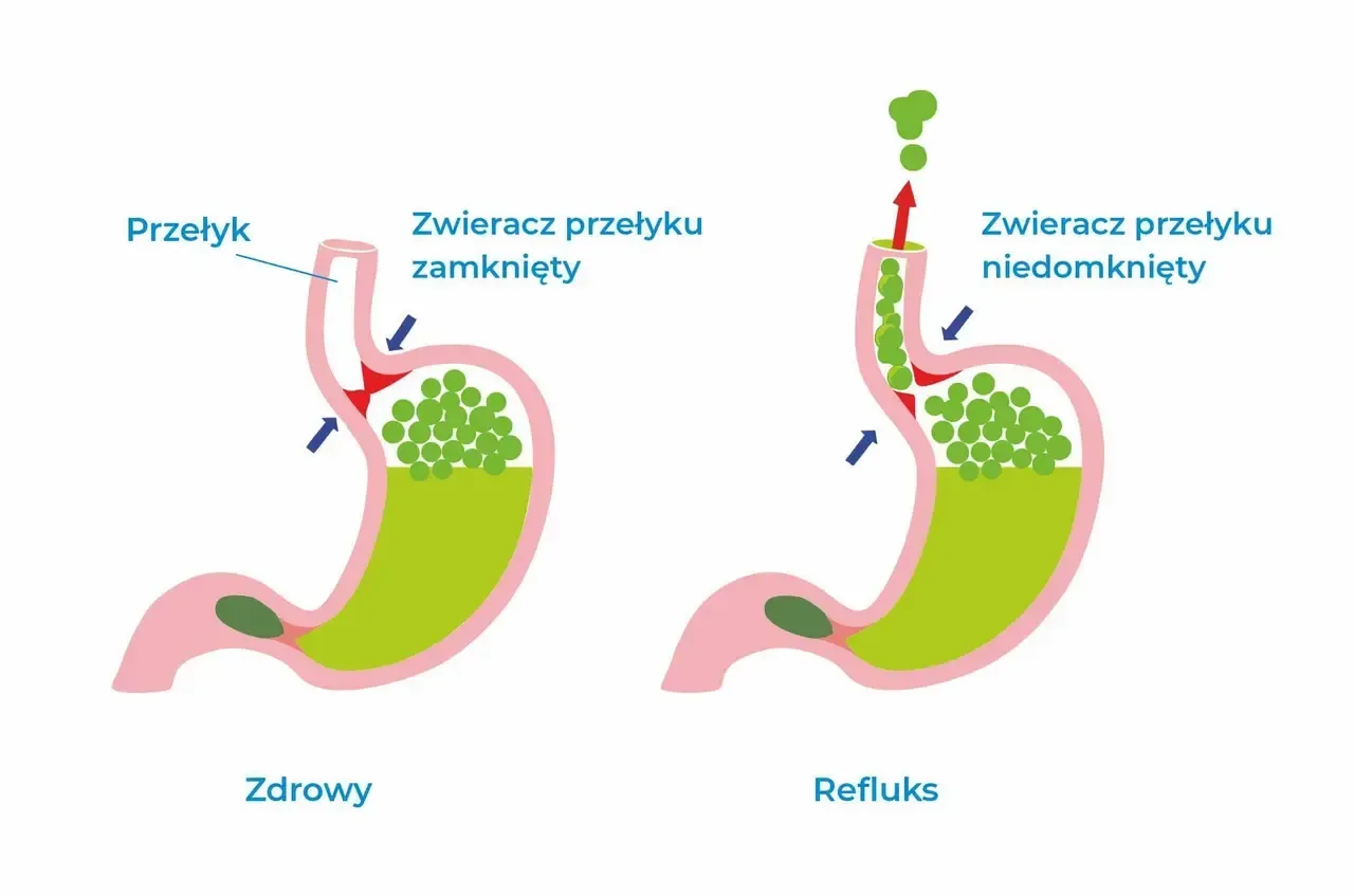 mechanizm refluksu przełykowego