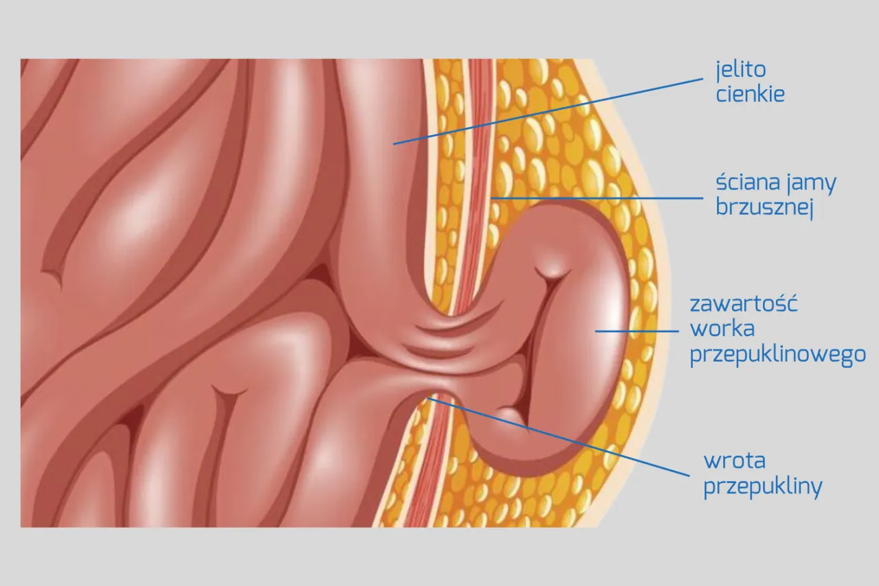 Przepuklina pachwinowa wczesne objawy