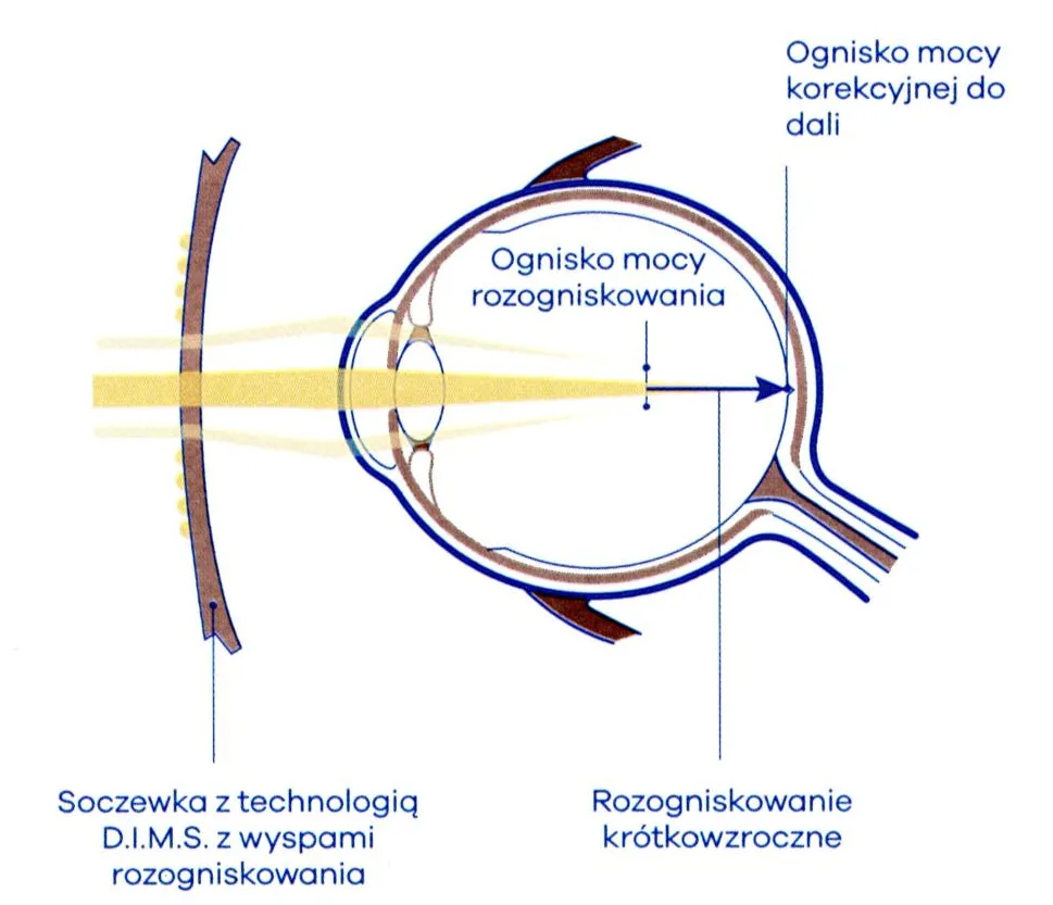 kr&oacute;tkowzroczność mechanizm oko schemat