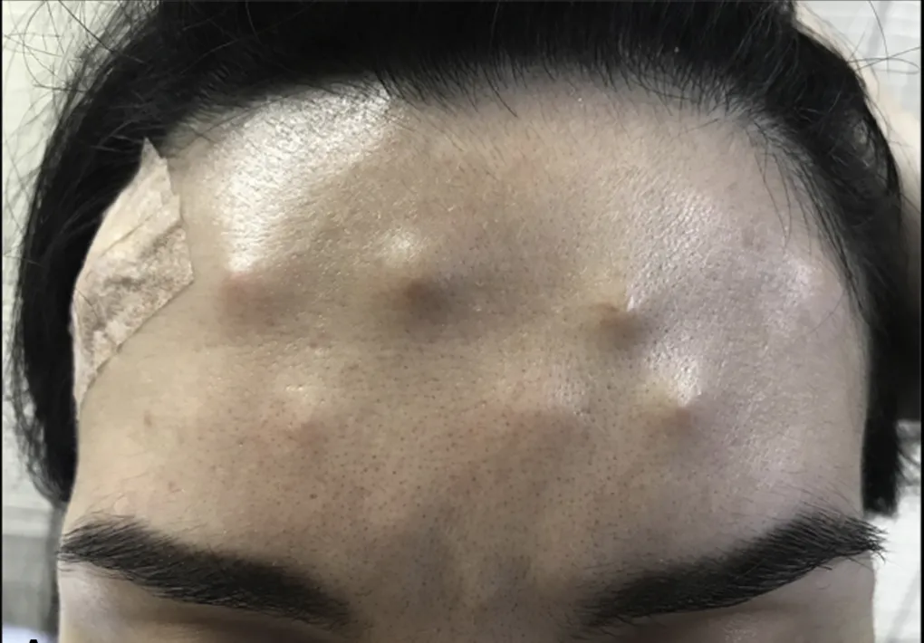 Poważne powikłania po botoksie