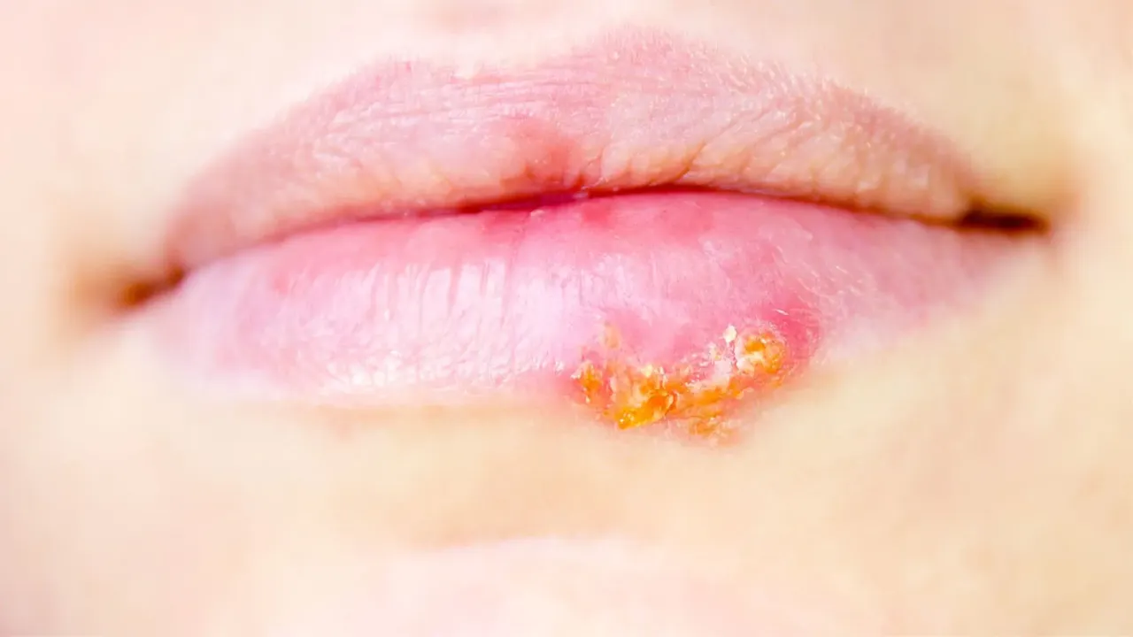 aktywna opryszczka na ustach