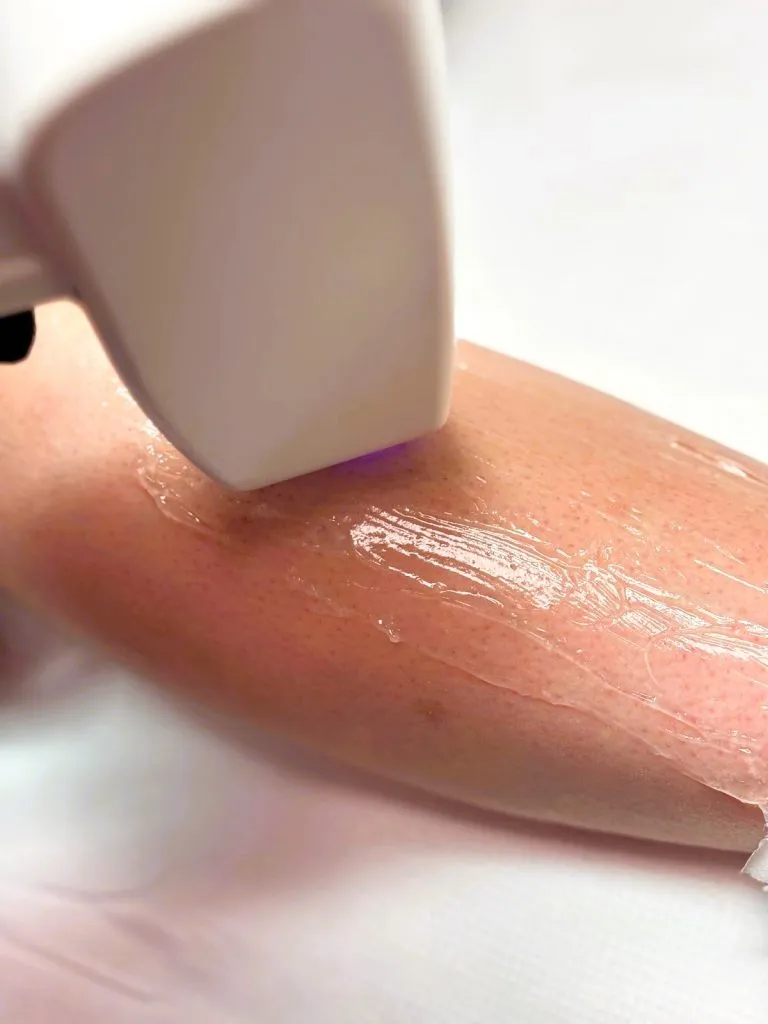 Zdjęcie Depilacja laserowa jaki laser wybrać dla najlepszych efektów?