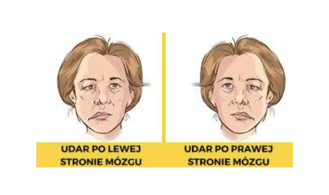Zdjęcie Objawy udaru prawej półkuli mózgu - rozpoznaj je natychmiast