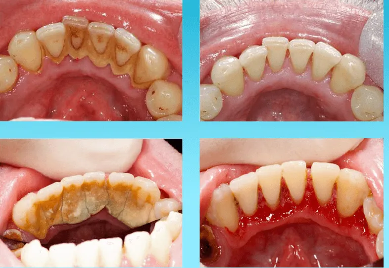 Zdjęcie Jak wygląda wybielanie zębów u dentysty? Poznaj szczegóły i efekty