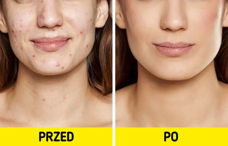 Zdjęcie Jak szybko pozbyć się pryszcza? Szybkie i bezpieczne metody