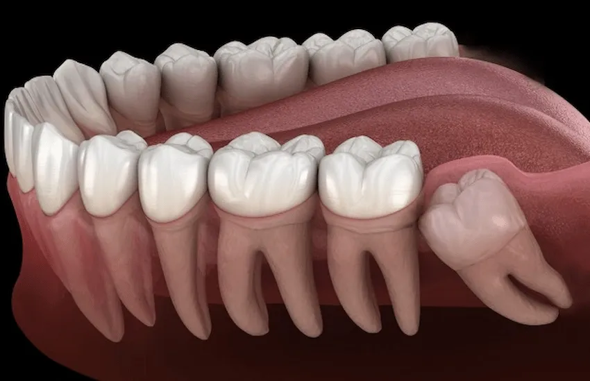 Zdjęcie Rosnący ząb mądrości: skuteczne sposoby na uśmierzenie bólu