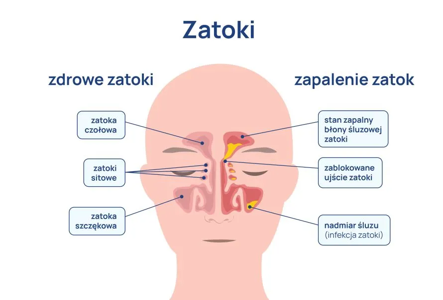Zdjęcie Jaki lekarz leczy zatoki? Kluczowe informacje, które musisz znać