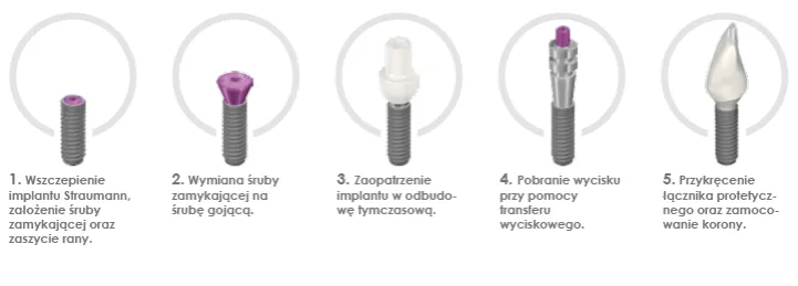 Etapy wstawiania implantu zęba