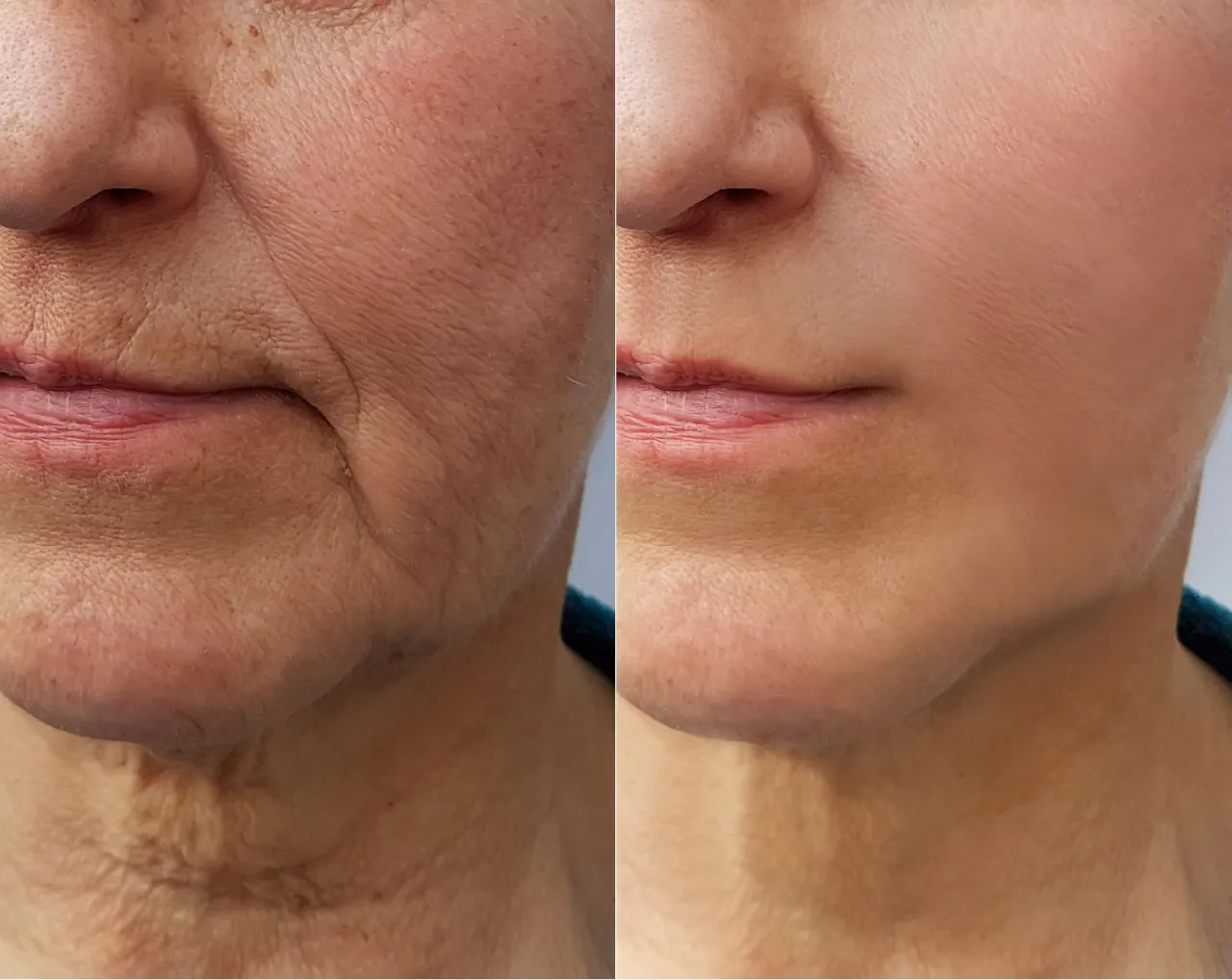 Profesjonalne zabiegi na twarz przed i po