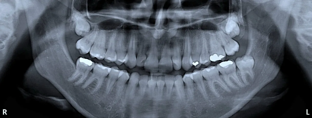 chirurgiczne usuwanie zęba rentgen