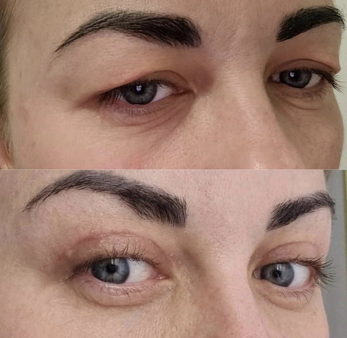 opadająca powieka botoks korekta