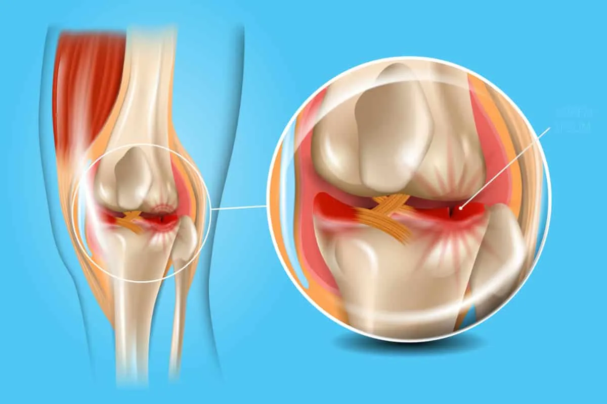 Obrazy uszkodzeń kolana: zerwane więzadło, pęknięta łąkotka, zwichnięta rzepka