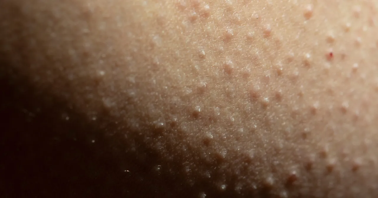 rogowacenie okołomieszkowe na udach