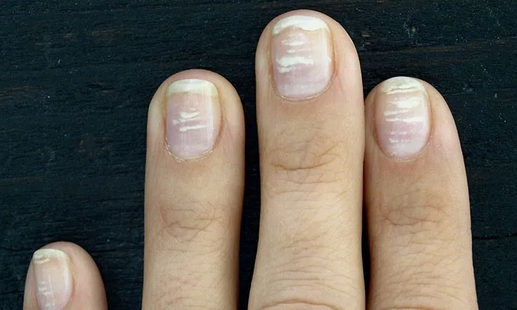 białe plamy na paznokciach przyczyny