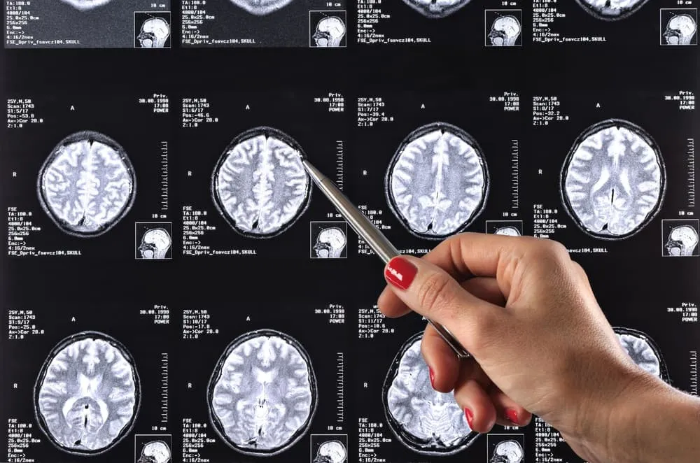 Objawy nerwiaka nerwu słuchowego infografika