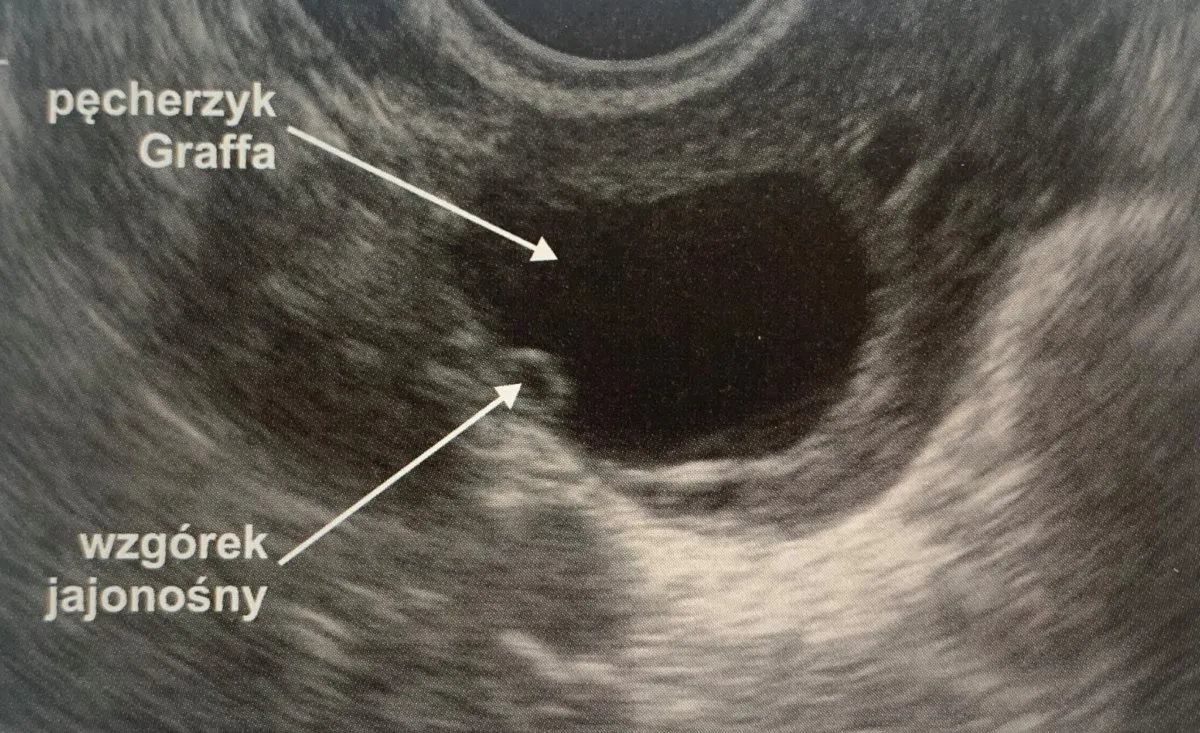 USG ginekologiczne jajnik pęcherzyk Graafa