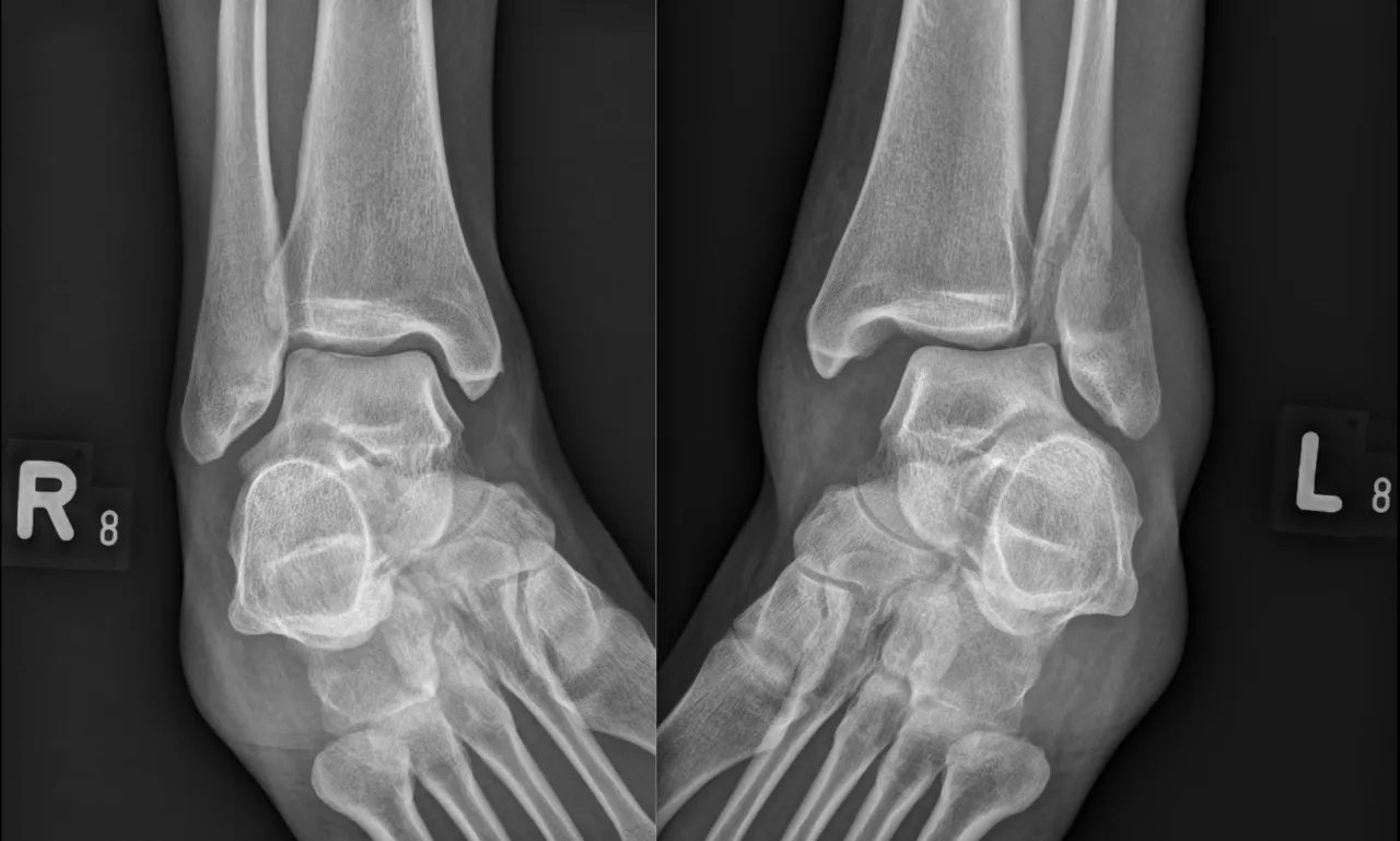Zwichnięta kostka objawy deformacja