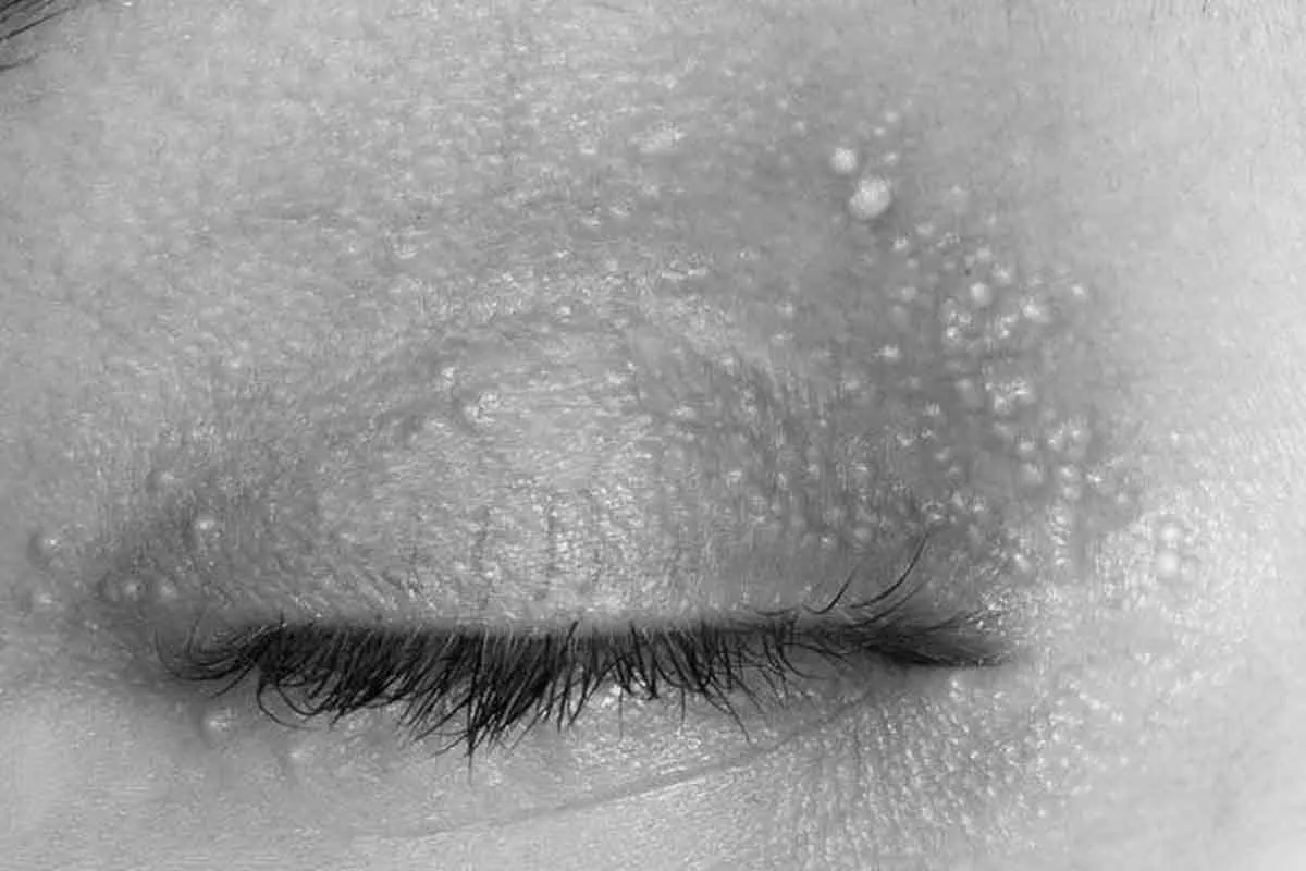 Na skórze powieki widocznych jest wiele drobnych, białych krostek, przypominających małe koraliki.