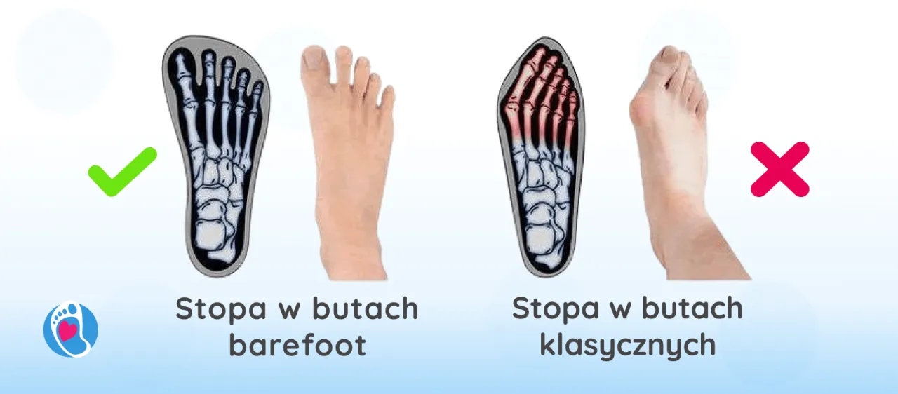 buty sprzyjające haluksom vs zdrowe obuwie