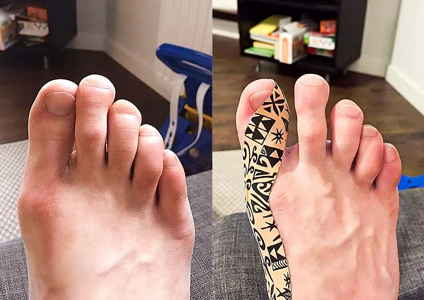 r&oacute;żne rodzaje plastr&oacute;w na haluksy