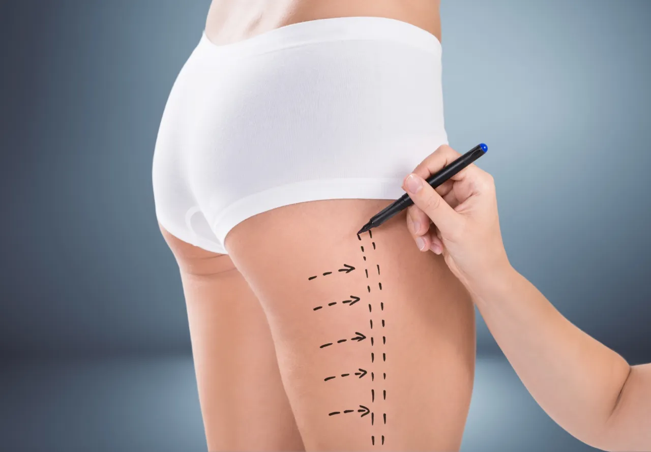 Kwalifikacje do liposukcji