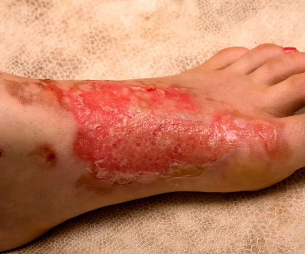 Niebezpieczeństwo ognia samozapłon poparzenia