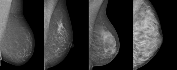 Dichtes Brustgewebe Ultraschall Mammographie