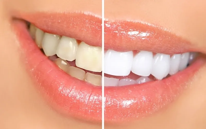 wybielanie zębów lampą before after