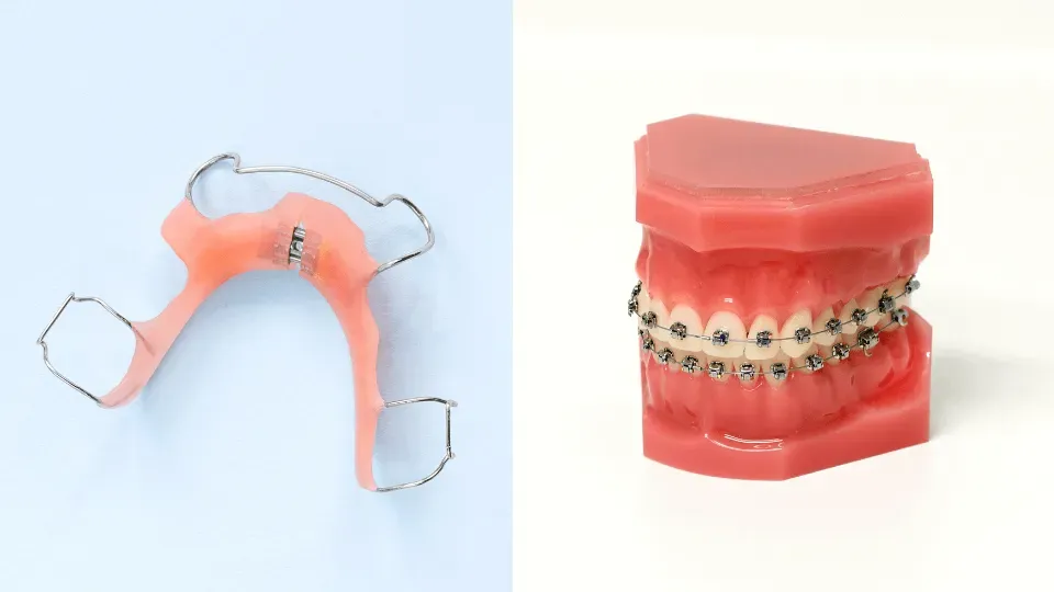 aparat ortodontyczny ruchomy i stały porównanie, ceny aparatów ortodontycznych