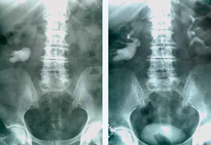 diagnostyka kamicy nerkowej usg tk