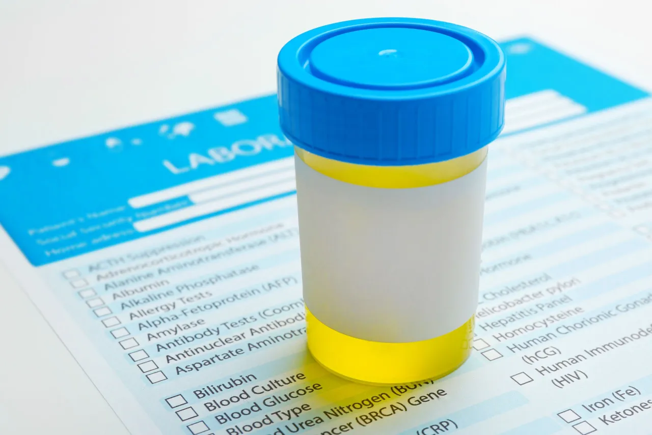 wpływ czasu na pr&oacute;bkę moczu do badania