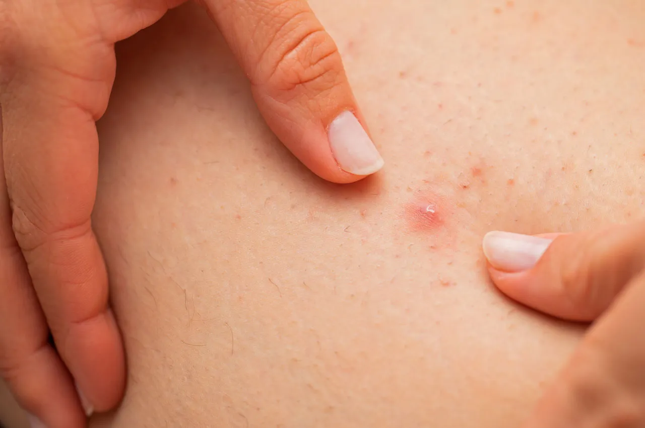 Dermatologiczne leczenie zapalenia mieszk&oacute;w włosowych