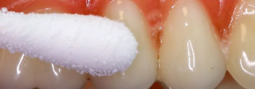 dentysta wykonuje test żywotności zęba na zimno