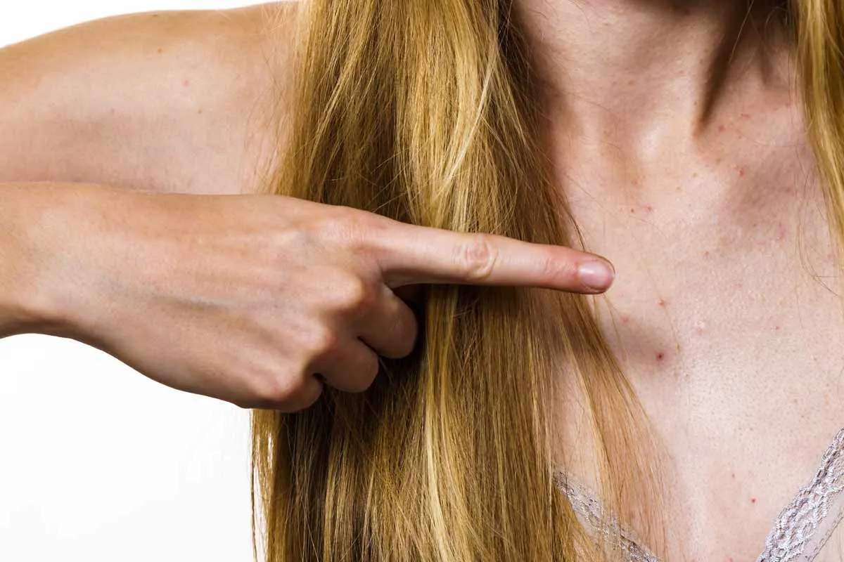 Dłoń wskazuje na pryszcze na dekolcie. Szukasz sposobu, jak pozbyć się pryszczy na dekolcie?