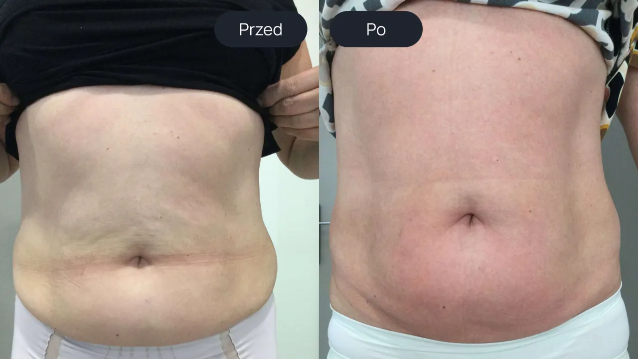 endermologia przed i po efekty