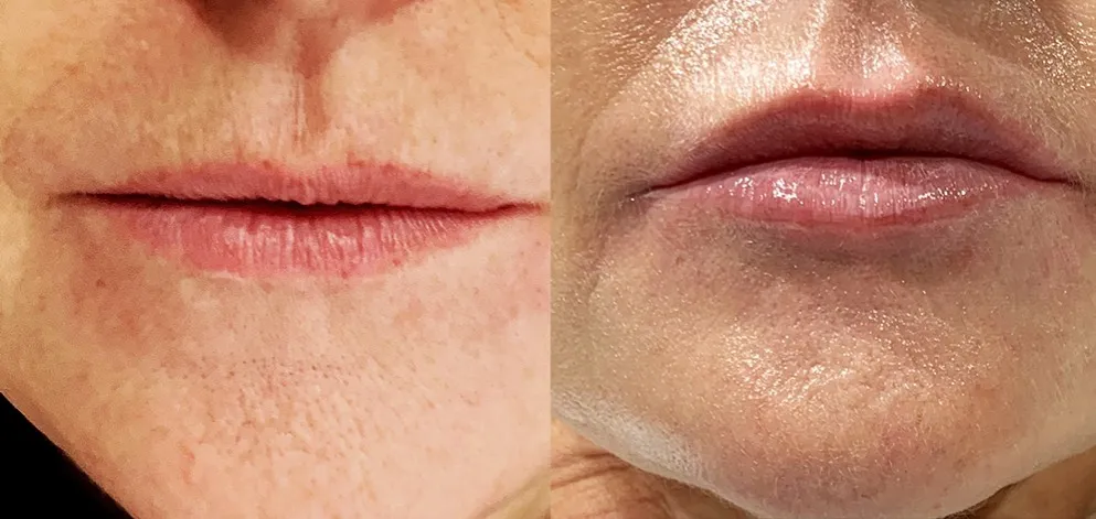 prawidłowa aplikacja kwasu hialuronowego