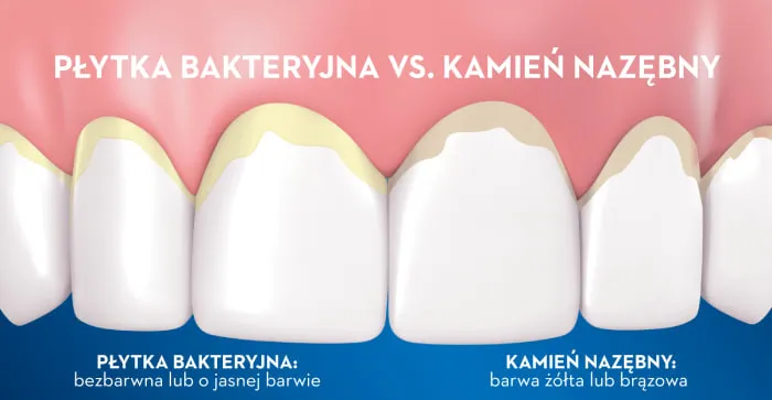 płytka nazębna i kamień nazębny