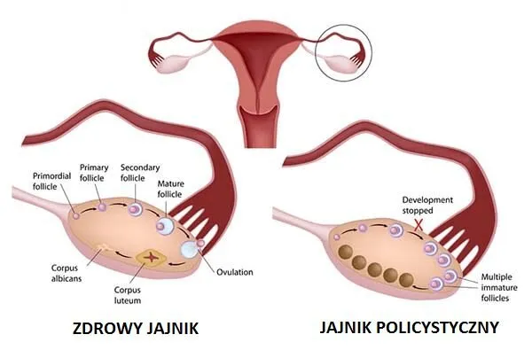 zespół policystycznych jajników schemat