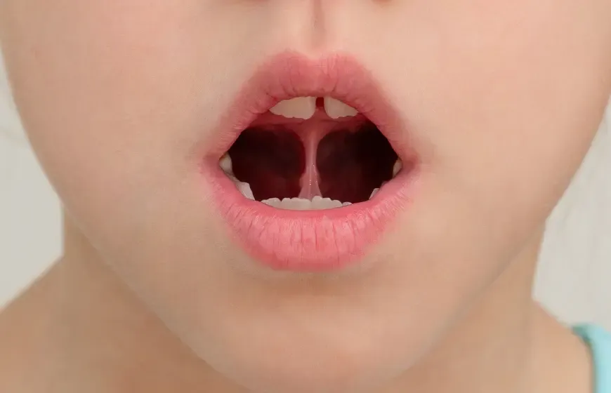 rekonwalescencja po podcięciu wędzidełka język