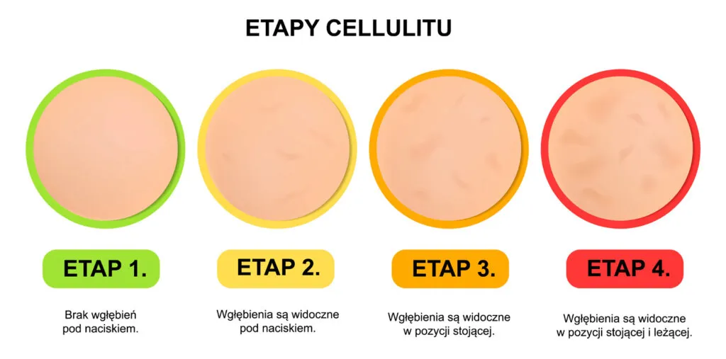 jak powstaje cellulit schemat etapy