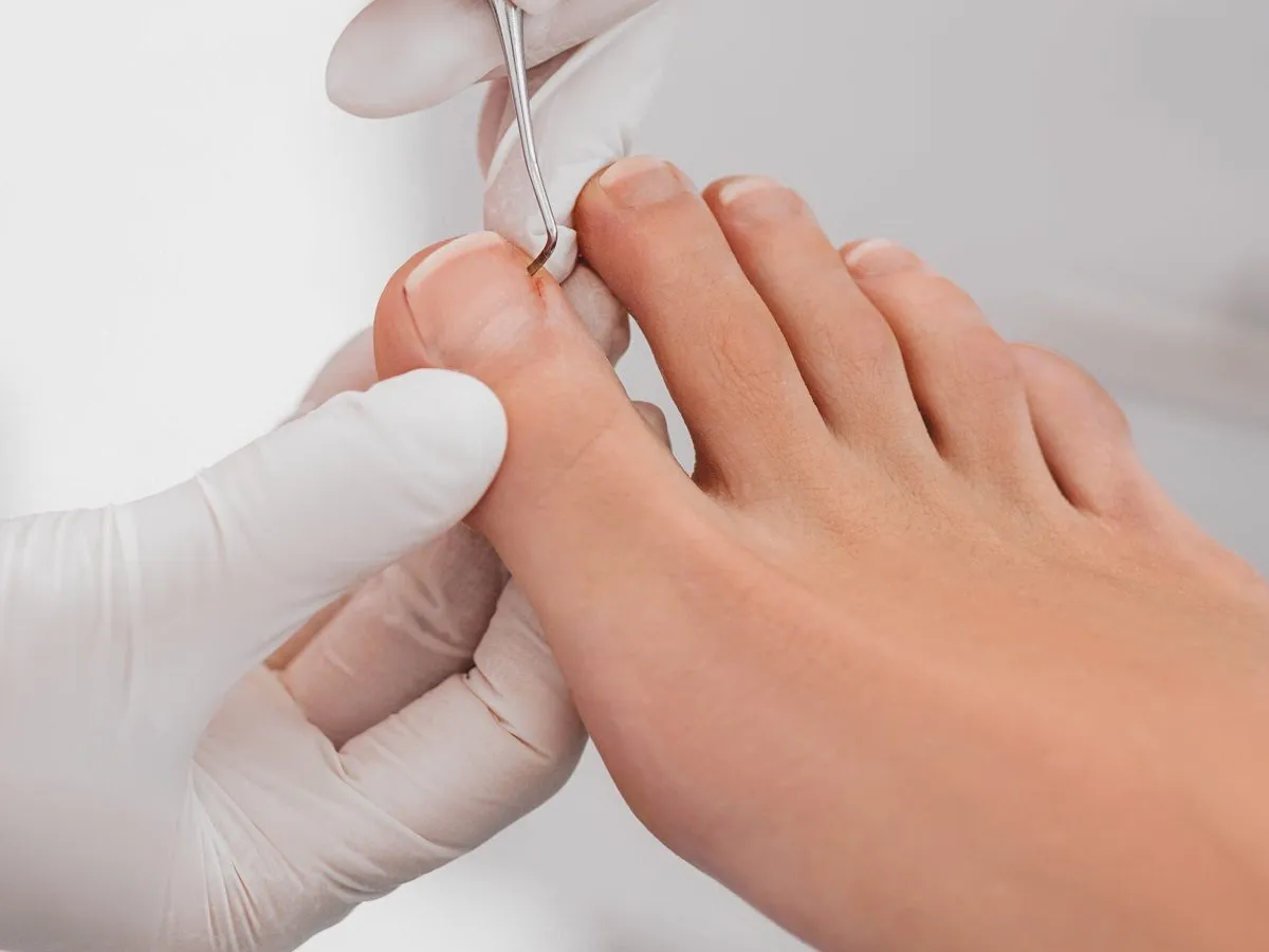 tamponada paznokcia krok po kroku