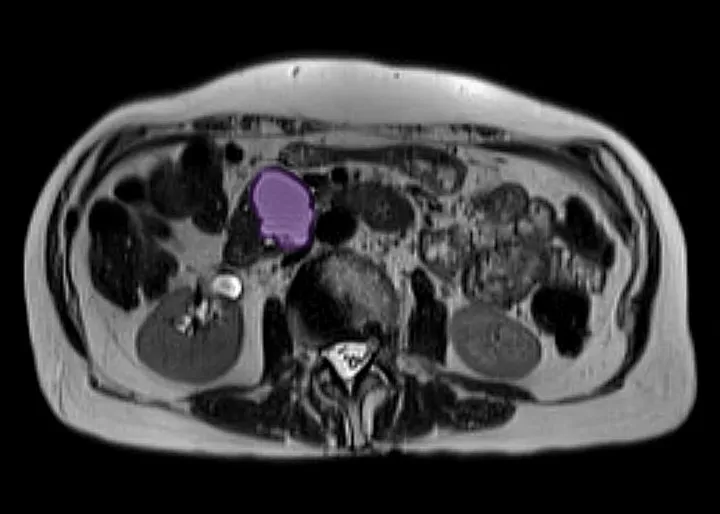 MRT und Endosonographie Bauchspeicheldrüse