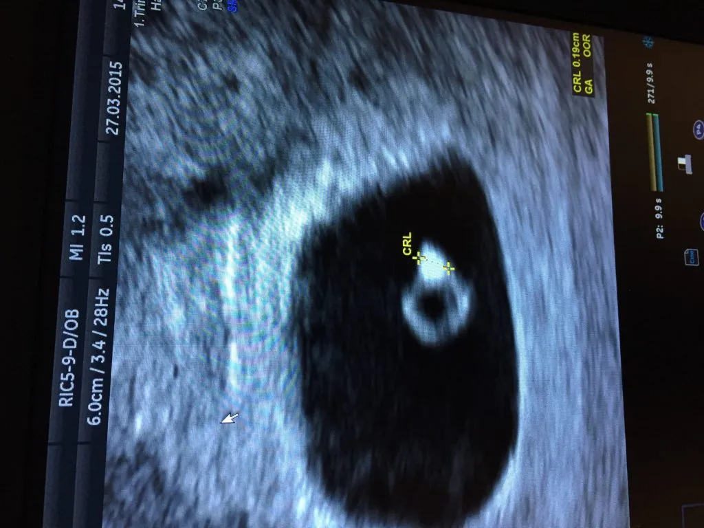 USG dopochwowe wczesna ciąża