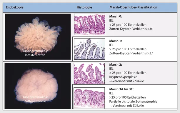 D&uuml;nndarmbiopsie Z&ouml;liakie Histologie Marsh Klassifikation