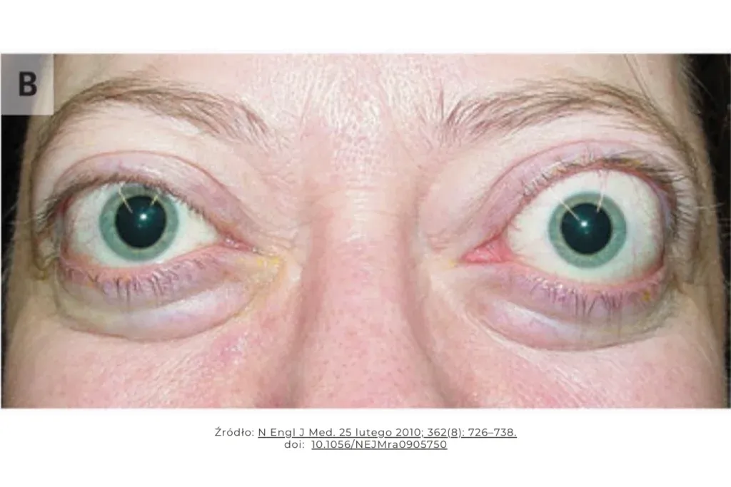 Osoba z objawami nadczynności tarczycy, np. wychudzona, z wytrzeszczem oczu